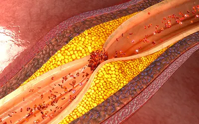 Medical illustration showing nerve inflammation and pain pathways associated with chronic pain conditions treated with ketamine infusion therapy.